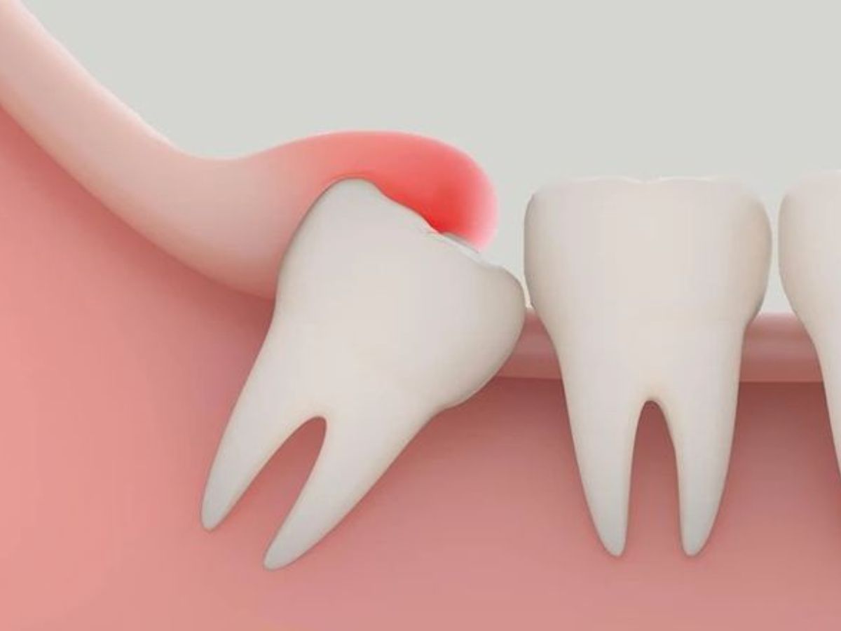 Lợi trùm răng khôn có tự hết không? Dấu hiệu và cách khắc phục hiệu quả
