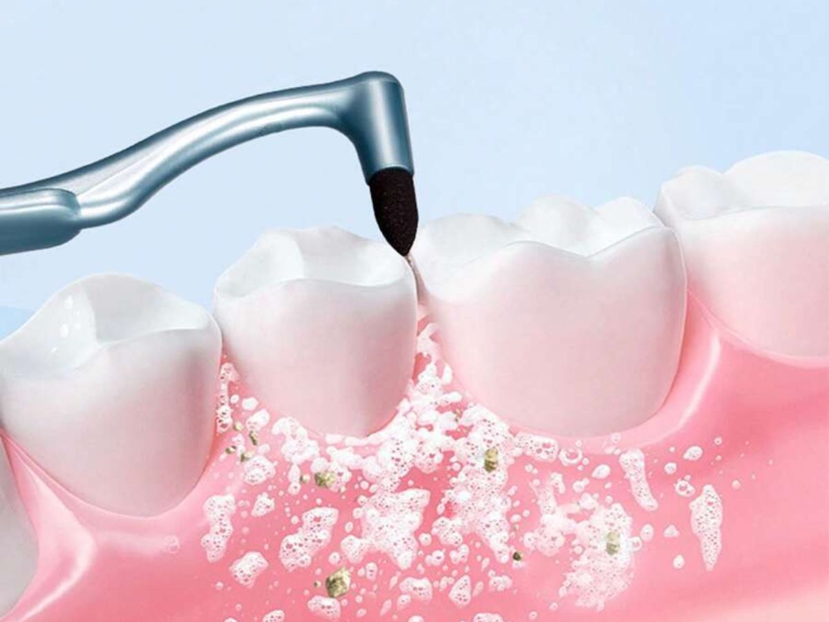 Đừng chủ quan: Viêm nha chu khi niềng răng có thể gây hậu quả nghiêm trọng