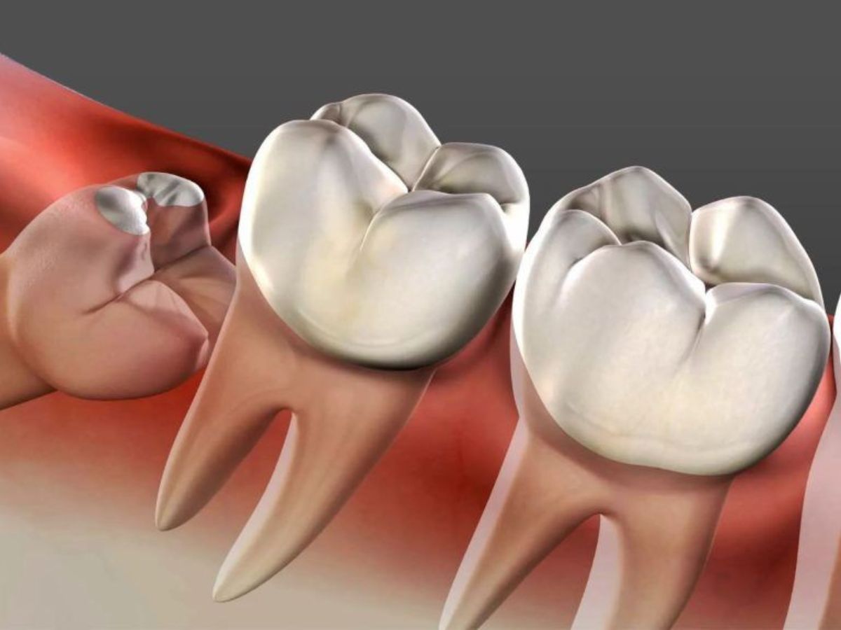 Mọc răng khôn bị sốt: Nguyên nhân, dấu hiệu và cách chăm sóc hiệu quả