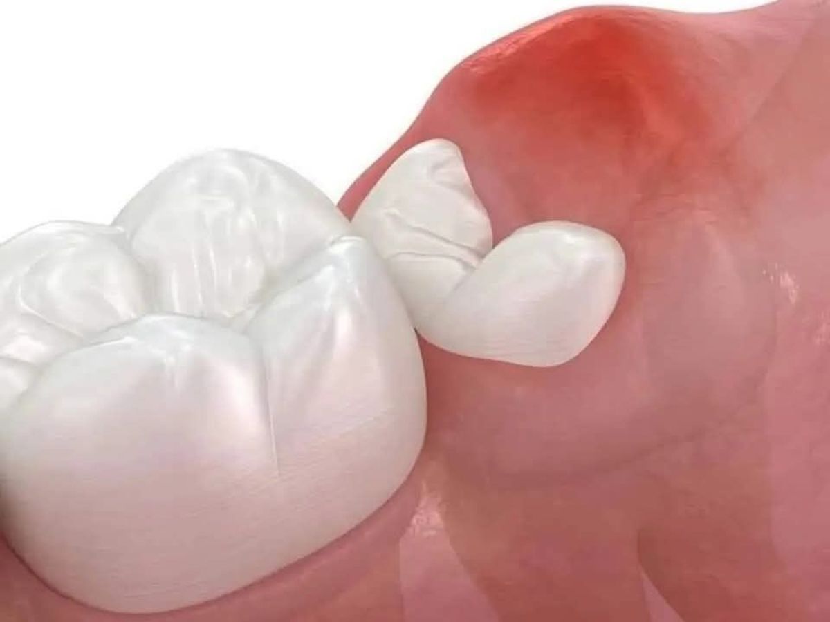 Áp Xe Răng Khôn Là Gì? Có Nên Nhổ Hay Không?