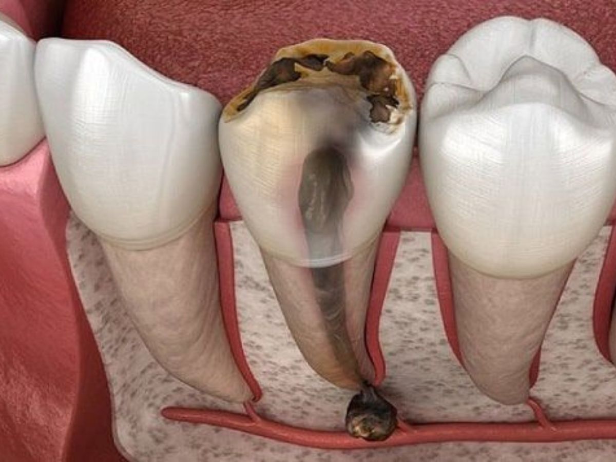 Dấu Hiệu Sâu Răng Nặng – Bị Sâu Răng Nặng Phải Làm Sao?