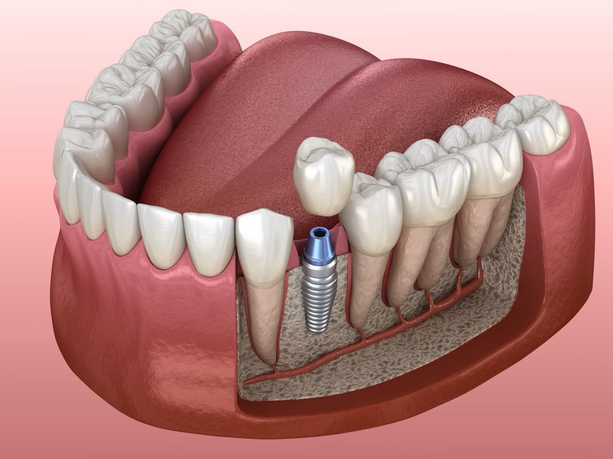 Trồng răng Implant ở Phường Đức Nhuận – Lấy lại nụ cười tự tin