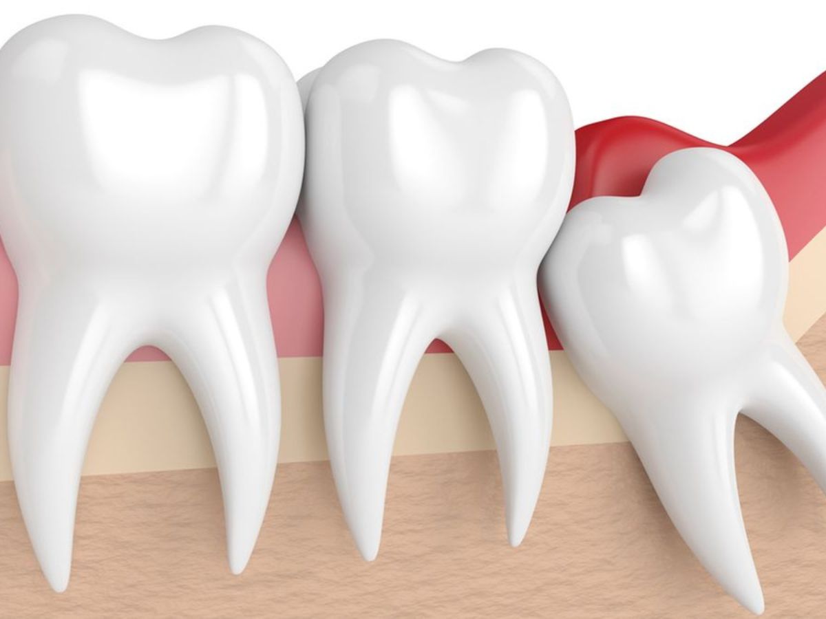 Răng Khôn Mọc Lệch Có Nguy Hiểm Không?