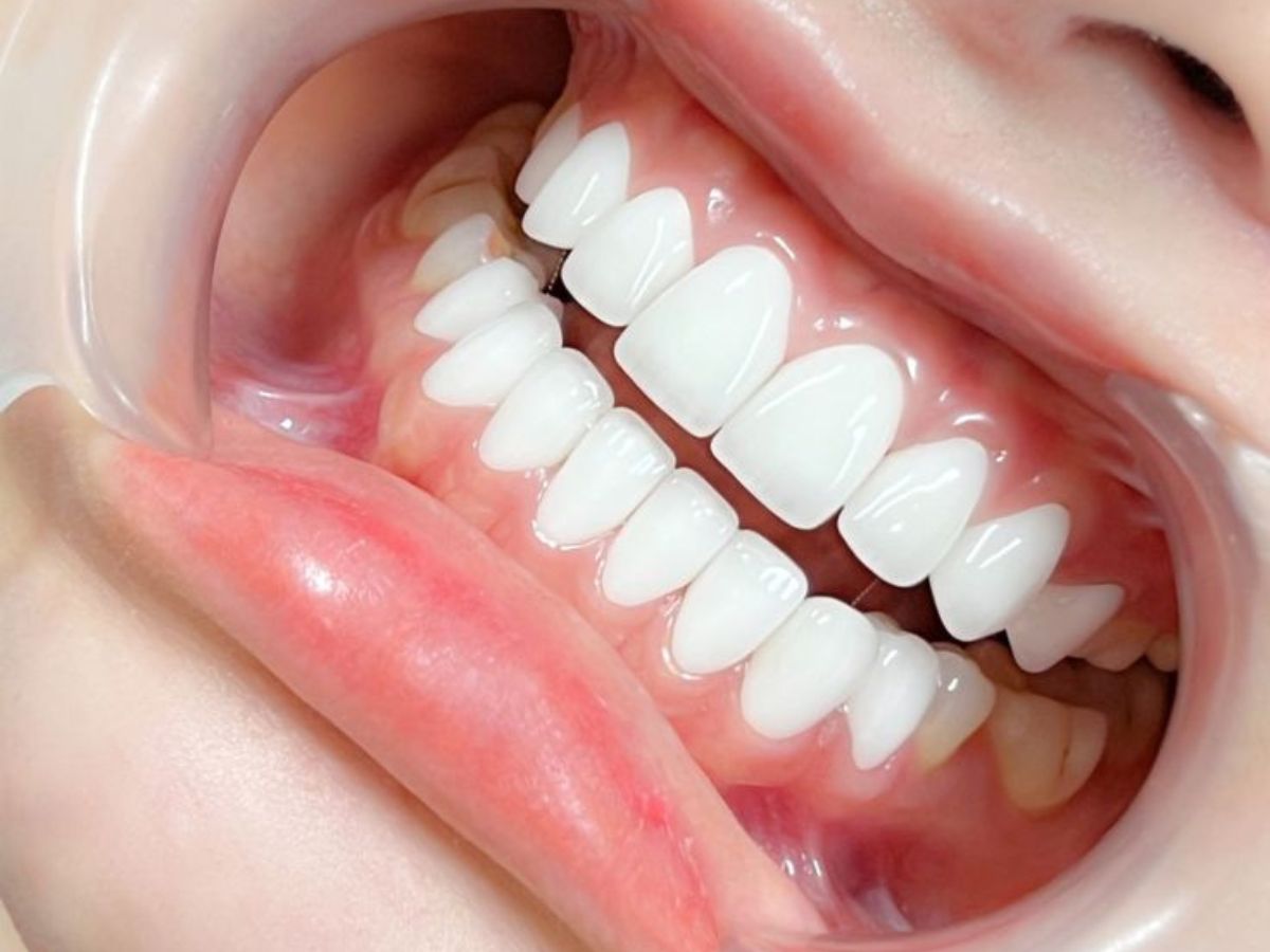 Răng Sứ Bị Ê Buốt Sau Khi Làm Có Bình Thường Không? Nguyên Nhân Và Cách Khắc Phục