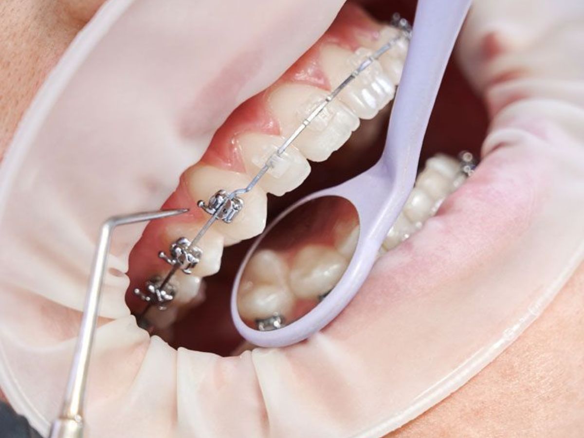 Niềng Răng Có Làm Thay Đổi Khuôn Mặt Không?