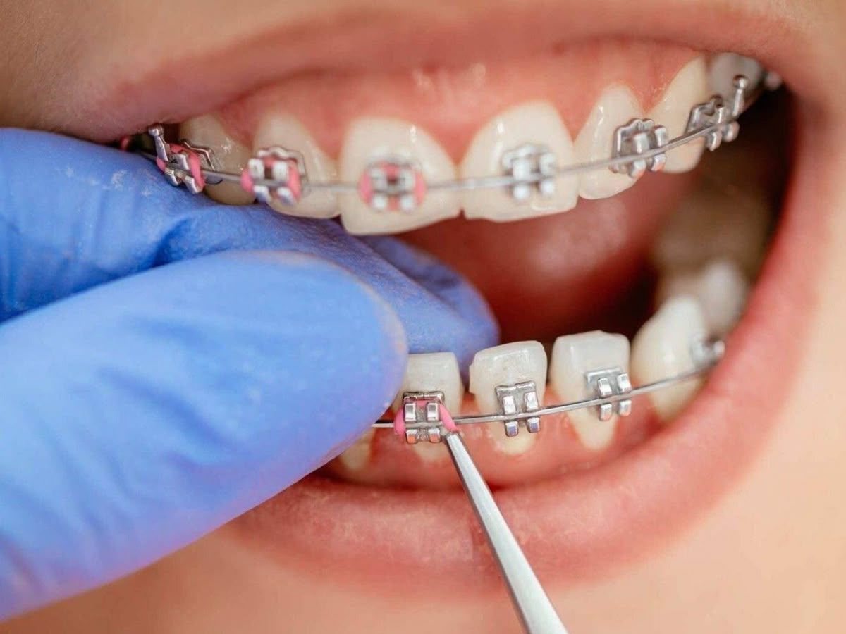 Niềng Răng Mắc Cài Và Invisalign: Nên Chọn Phương Pháp Nào Phù Hợp Với Bạn?