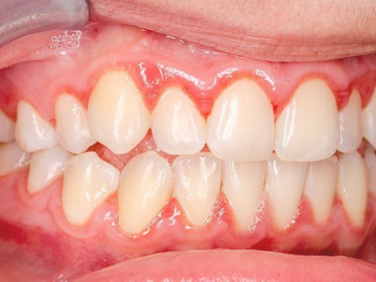 Chảy Máu Chân Răng Là Dấu Hiệu Bệnh Gì? Nguyên Nhân Và Cách Điều Trị Hiệu Quả