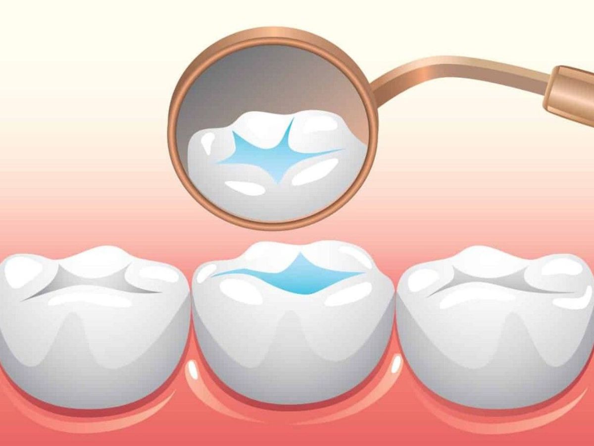 Trám Răng Giữ Được Bao Lâu? Những Yếu Tố Quyết Định Độ Bền Của Miếng Trám