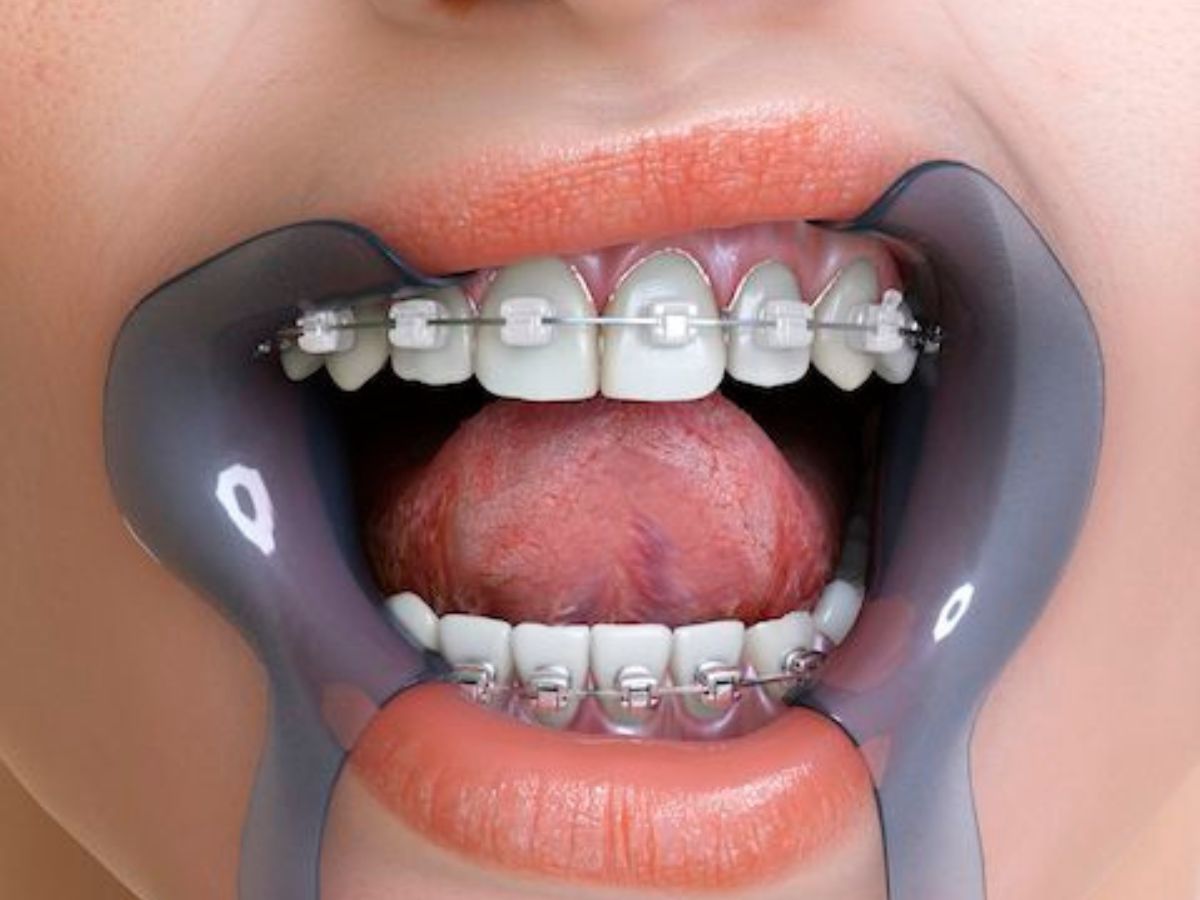 Điều Gì Quyết Định Thành Công Của Một Ca Niềng Răng? 7 Yếu Tố Bạn Cần Biết