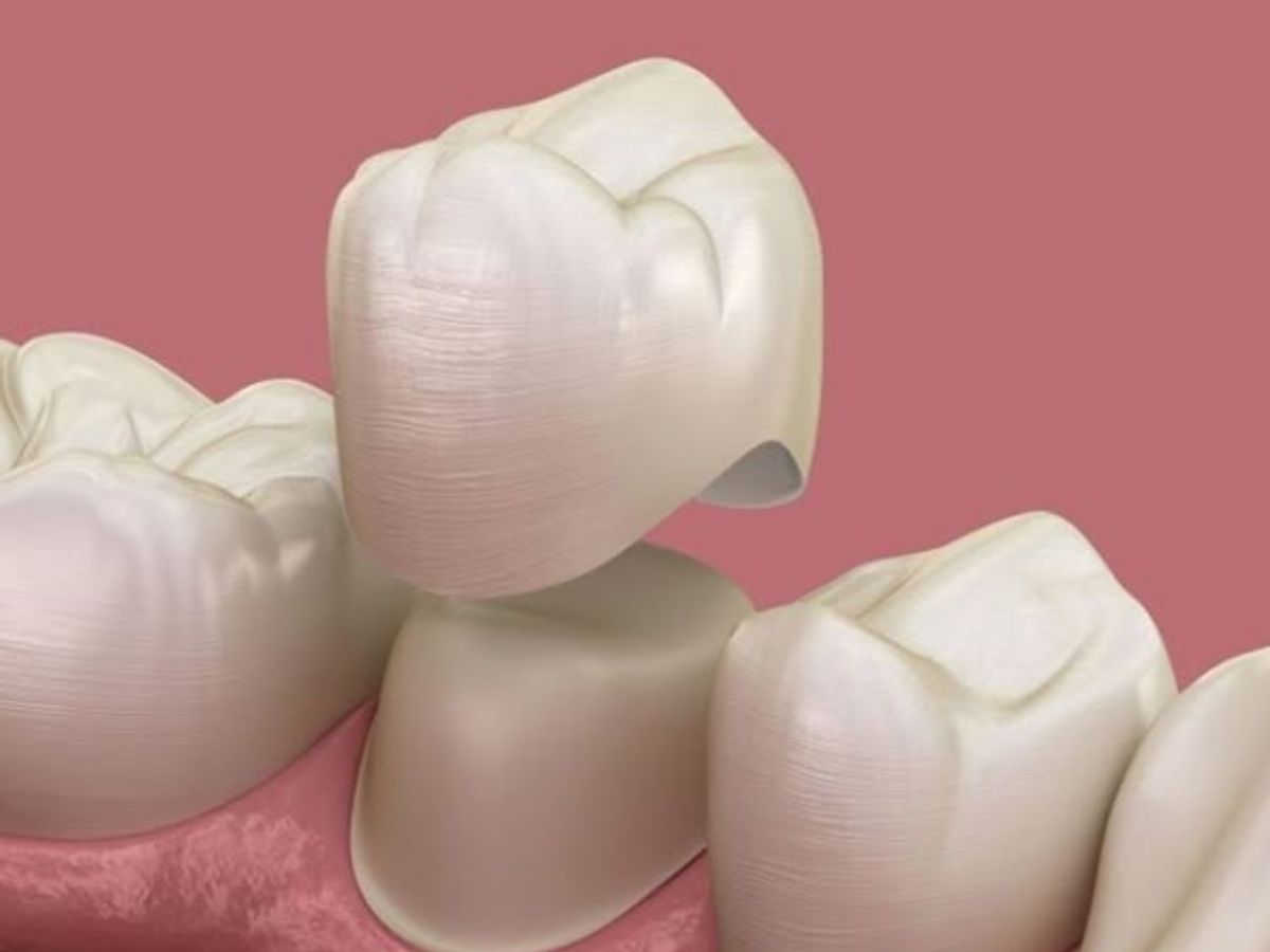 Những Dấu Hiệu Răng Sứ Bị Hỏng Cần Thay Mới: Đừng Chủ Quan Để Tránh Biến Chứng