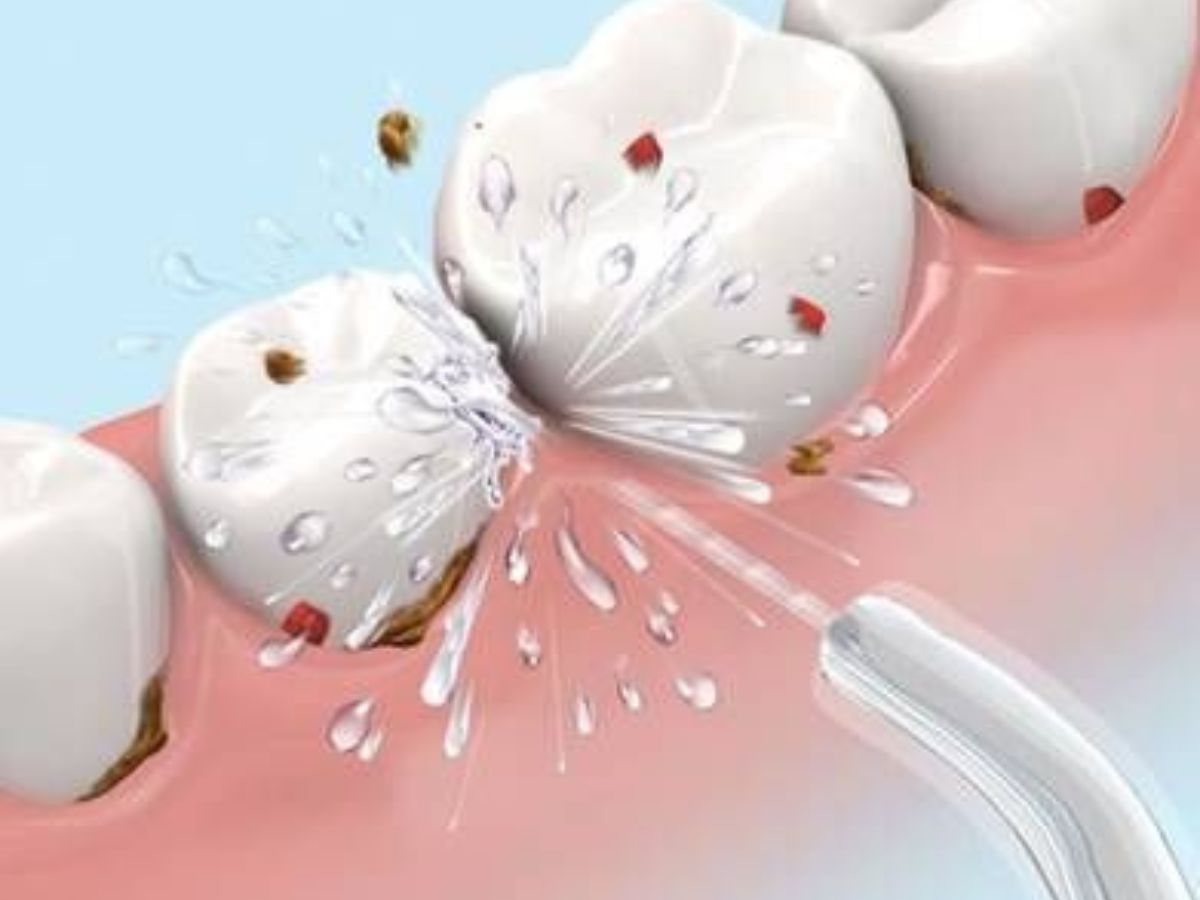 Tăm Nước Có Thay Thế Chỉ Nha Khoa Được Không? Giải Đáp Từ Chuyên Gia Nha Khoa