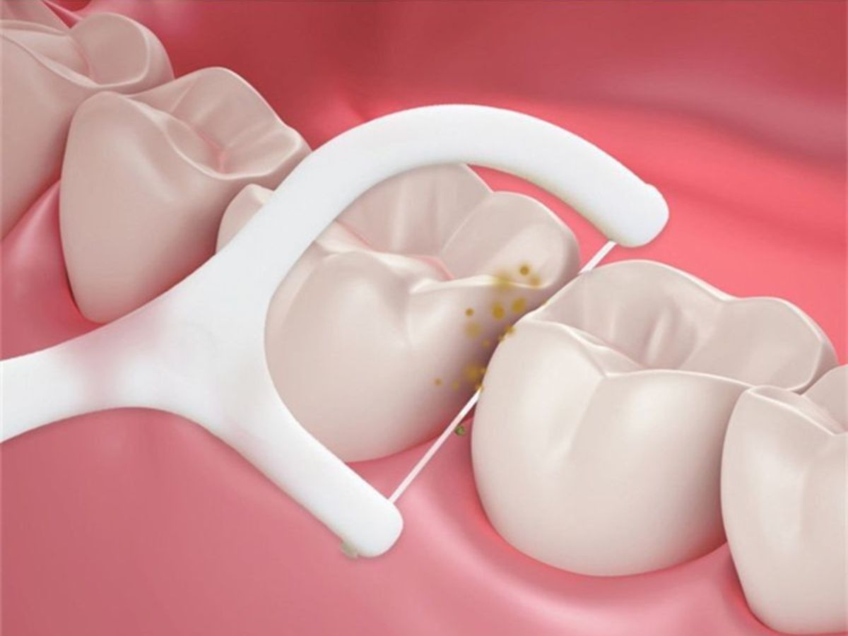 Vì Sao Đánh Răng Đều Nhưng Vẫn Bị Sâu Răng? Nguyên Nhân Và Cách Phòng Ngừa