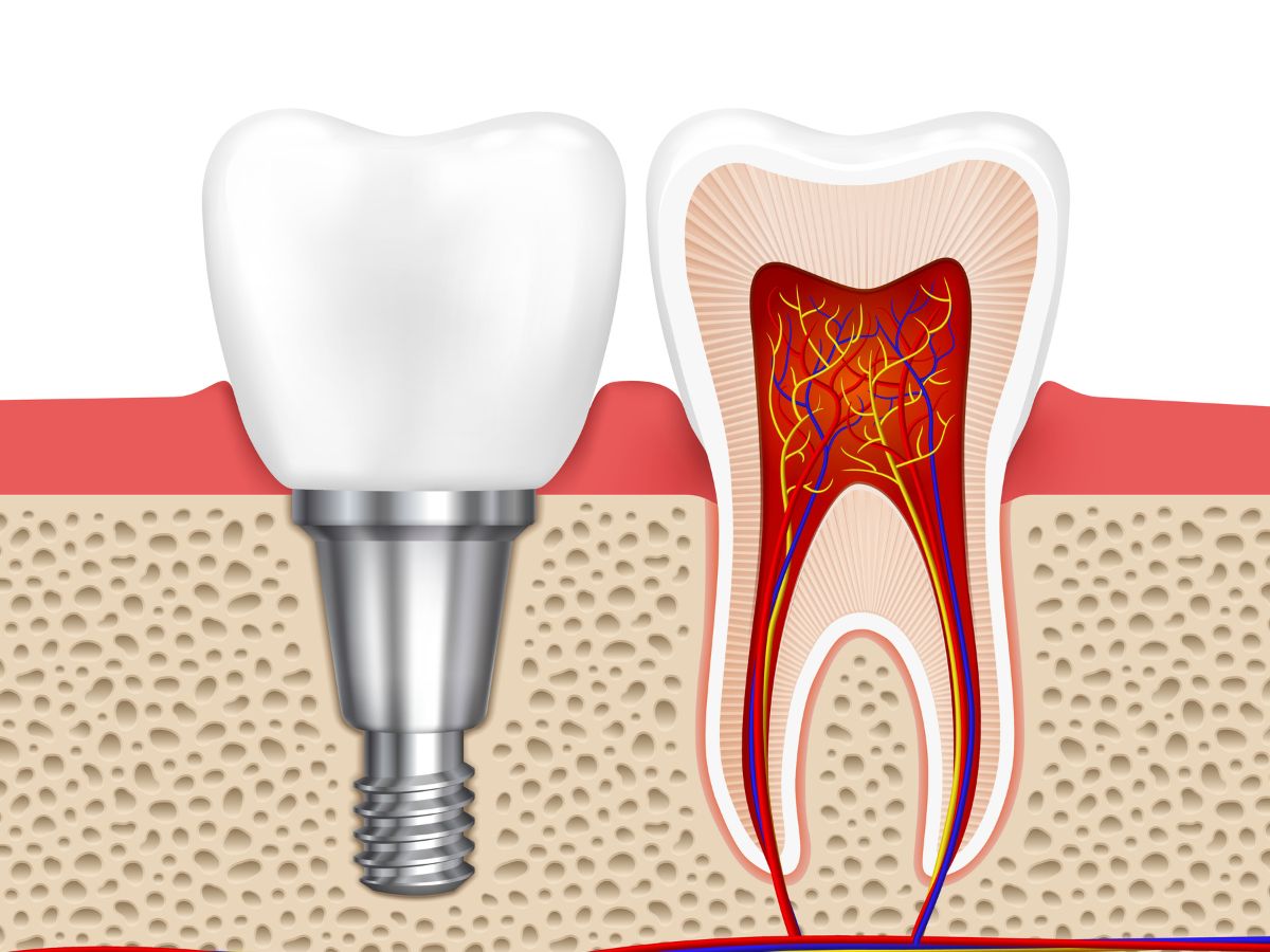 Khi Mất Răng Lâu Năm Có Trồng Implant Được Không? Giải Đáp Từ Bác Sĩ Nha Khoa