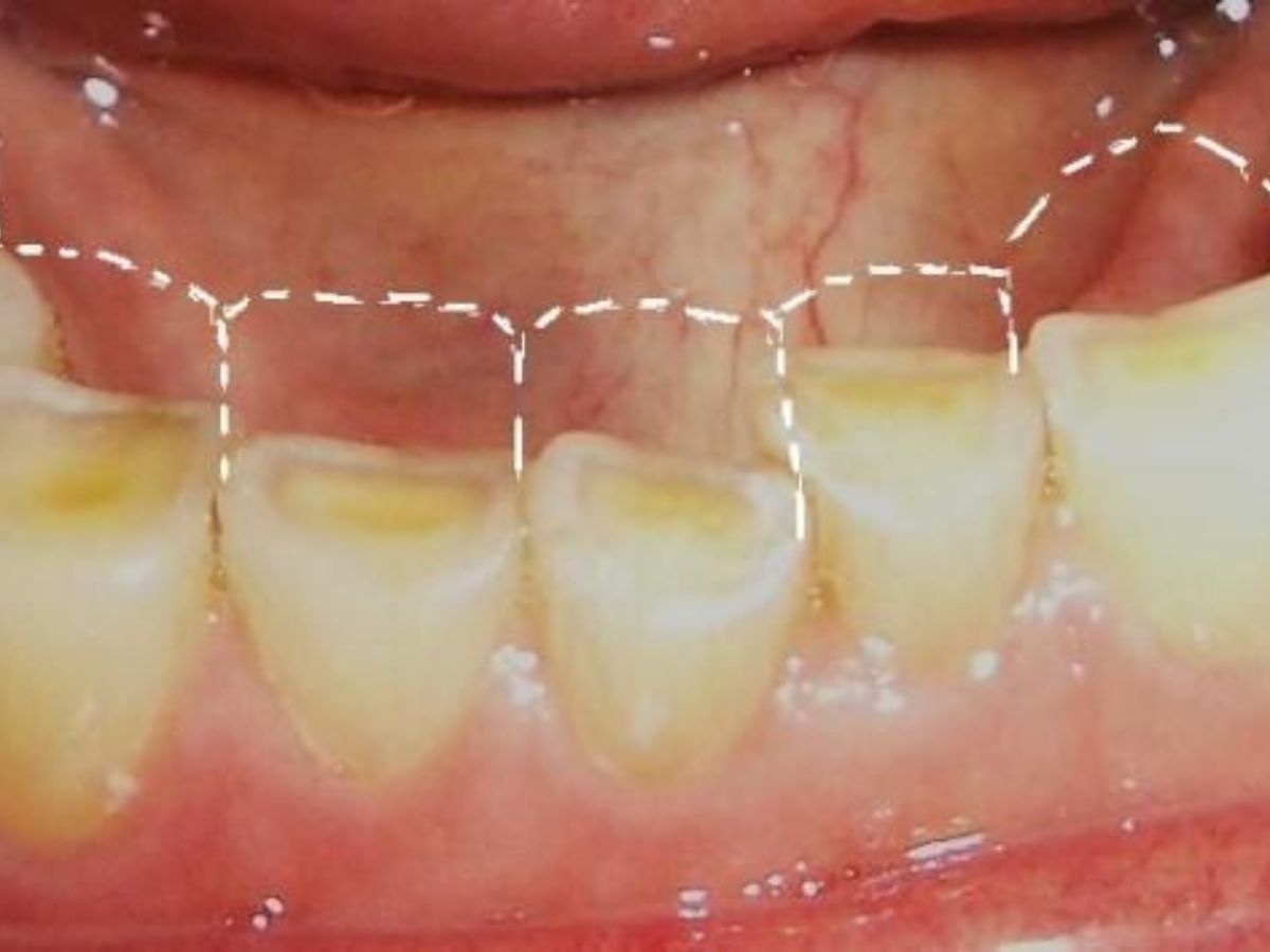 Răng Bị Mòn Cổ Răng Là Gì? Nguyên Nhân, Dấu Hiệu Và Cách Điều Trị Hiệu Quả