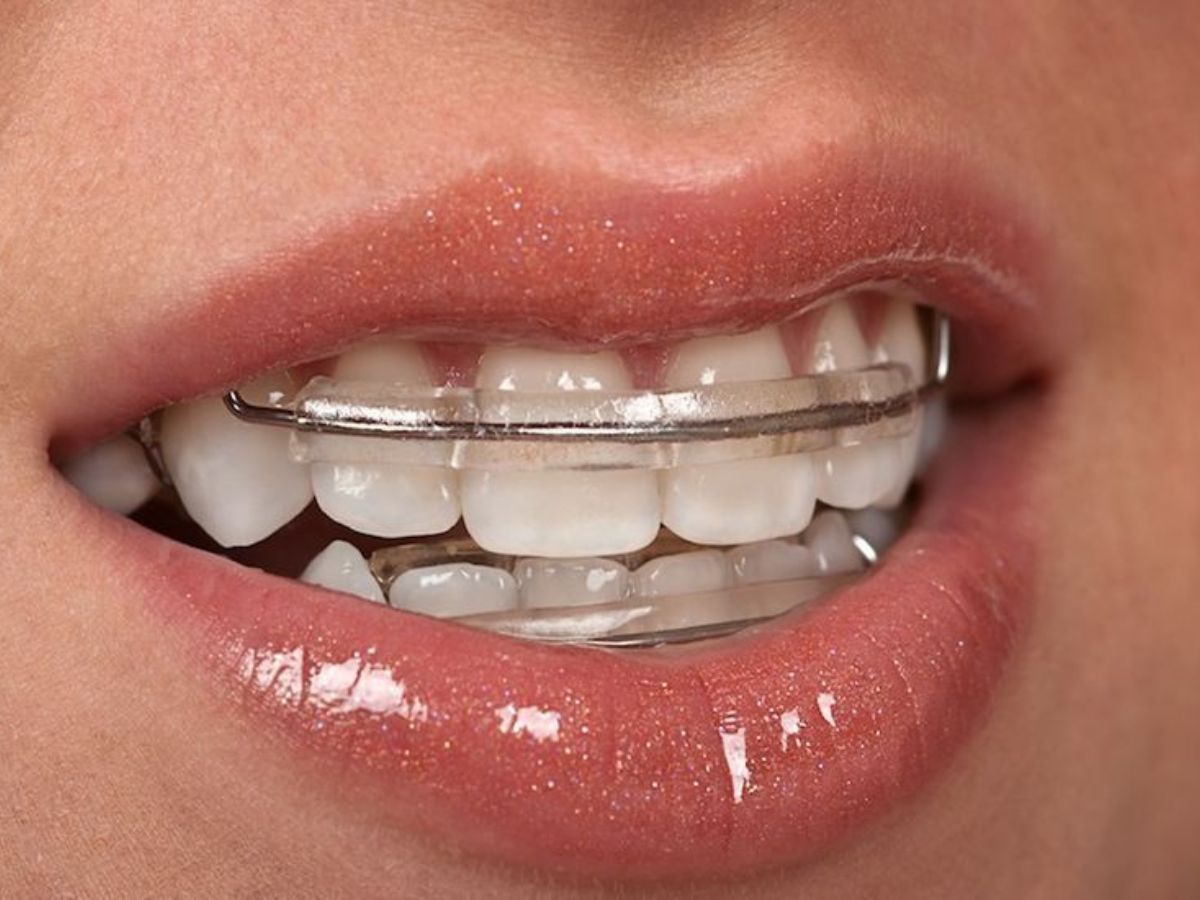 Niềng Răng Có Giúp Cải Thiện Phát Âm Không? Giải Đáp Từ Góc Độ Chuyên Gia
