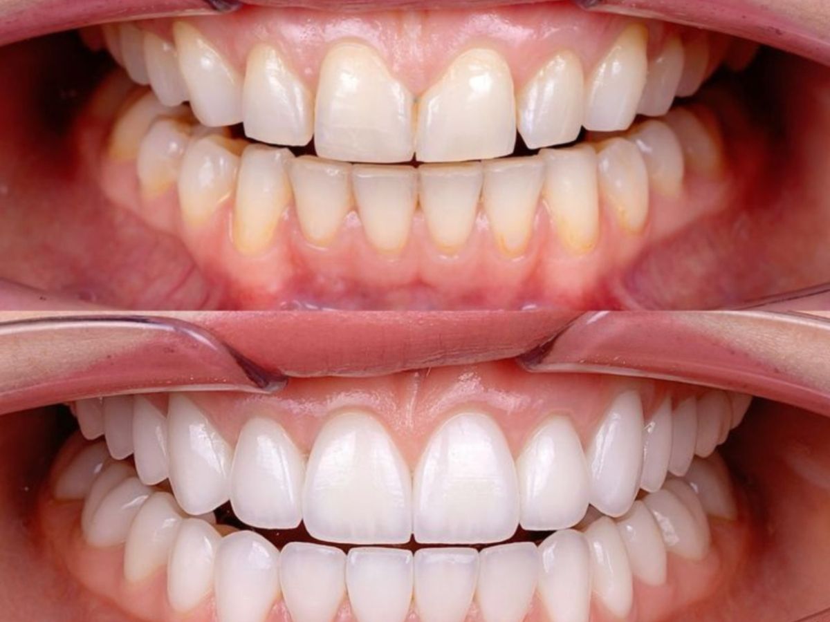 Cách khắc phục bọc răng sứ bị viêm lợi hiệu quả và an toàn