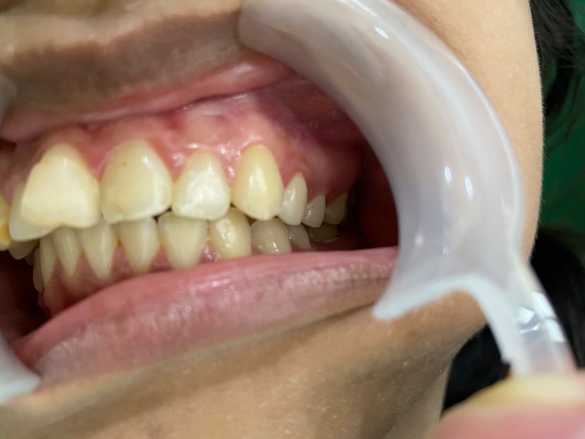 Trẻ Hay Ngậm Ngón Tay Có Ảnh Hưởng Đến Răng Không? Dấu Hiệu Và Cách Khắc Phục
