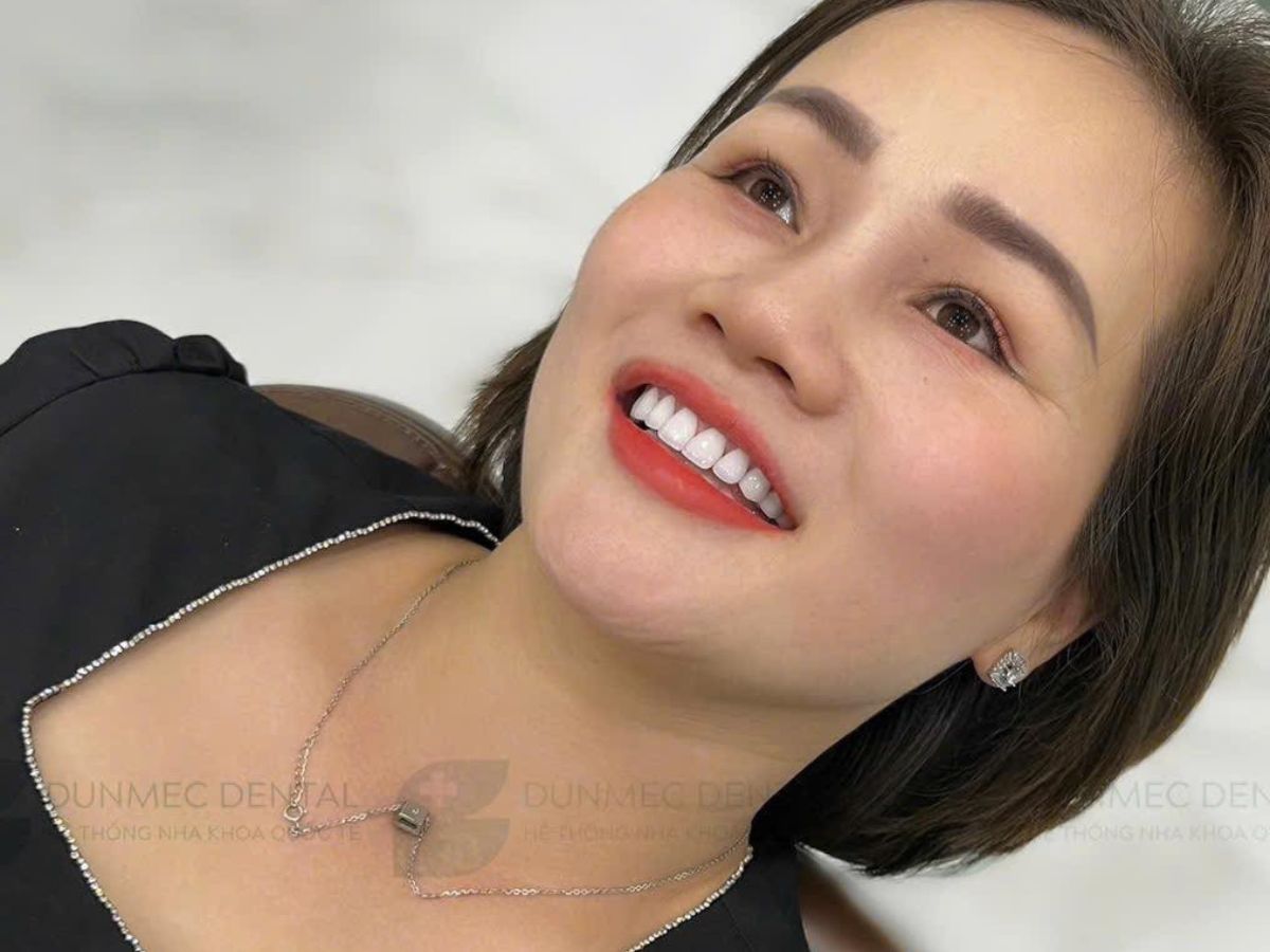 Bọc Răng Sứ Có Điều Trị Được Răng Thưa Không? Khi Nào Nên Bọc Sứ?