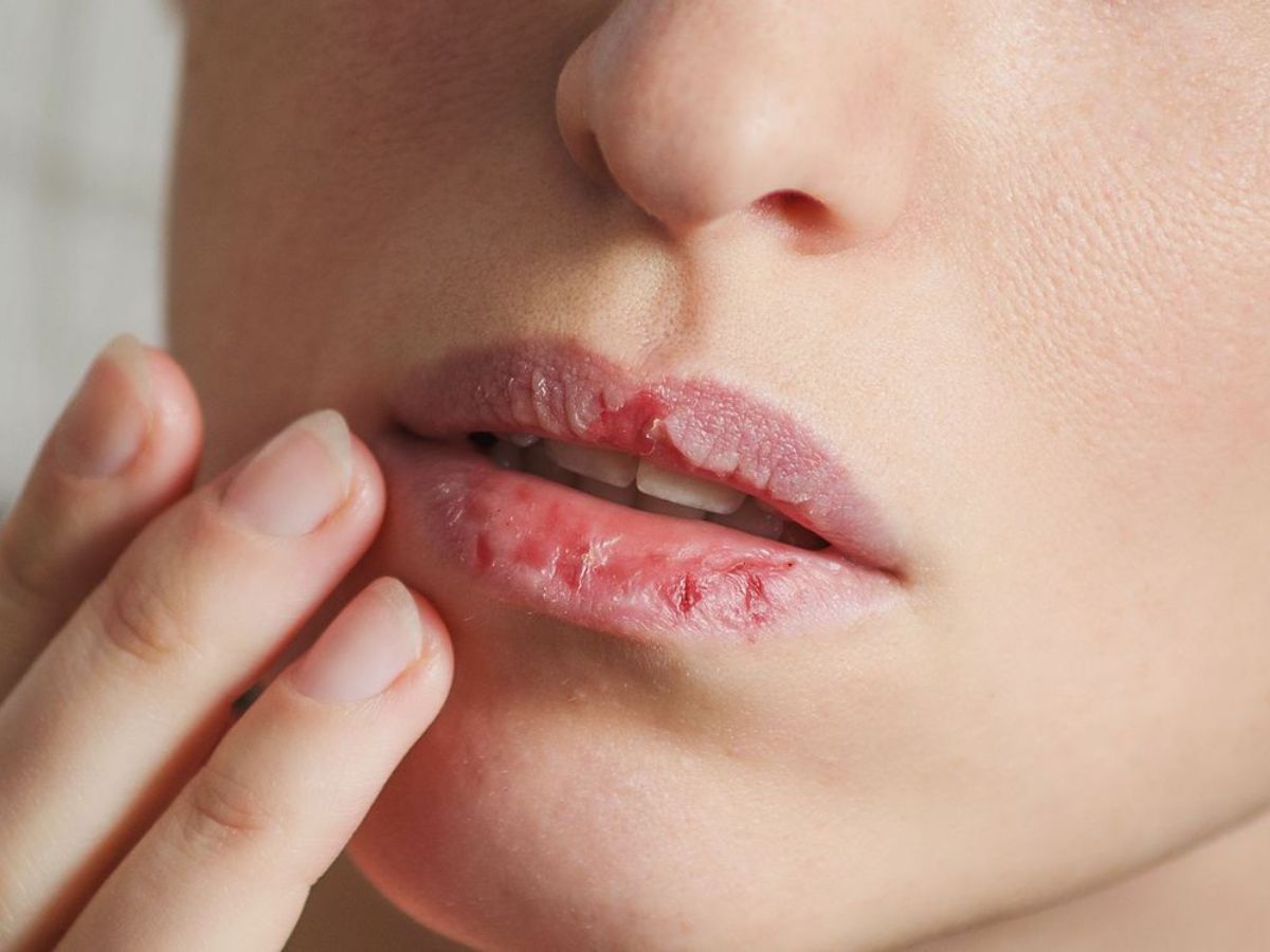 Miệng Khô Kéo Dài Có Ảnh Hưởng Đến Sức Khỏe Răng Miệng Không? Nguyên Nhân Và Cách Khắc Phục