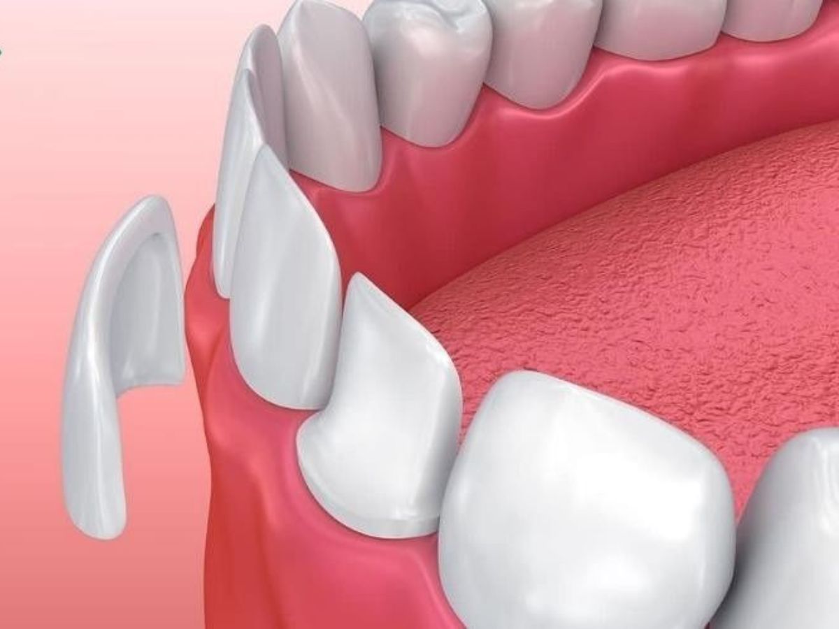 Răng Khấp Khểnh Nhẹ Nên Niềng Hay Bọc Sứ? So Sánh Chi Tiết Để Chọn Đúng Phương Pháp