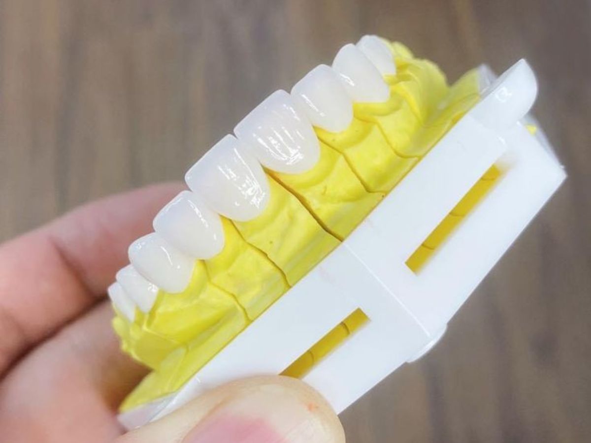 Bọc răng sứ bao lâu thì hỏng? Độ bền làm răng sứ duy trì bao lâu?
