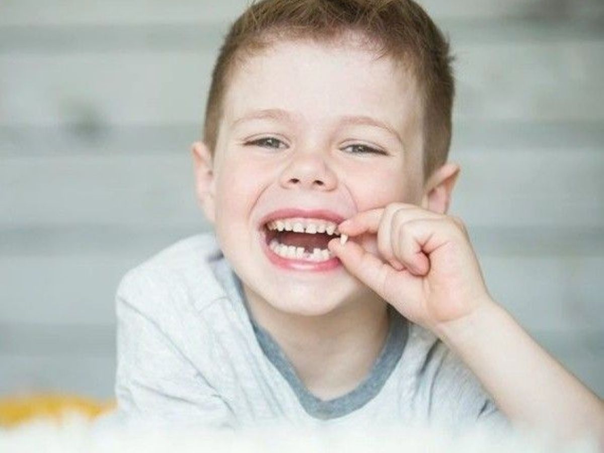 Răng mọc lẫy ở trẻ là gì? Dấu hiệu nhận biết và cách xử lý phù hợp