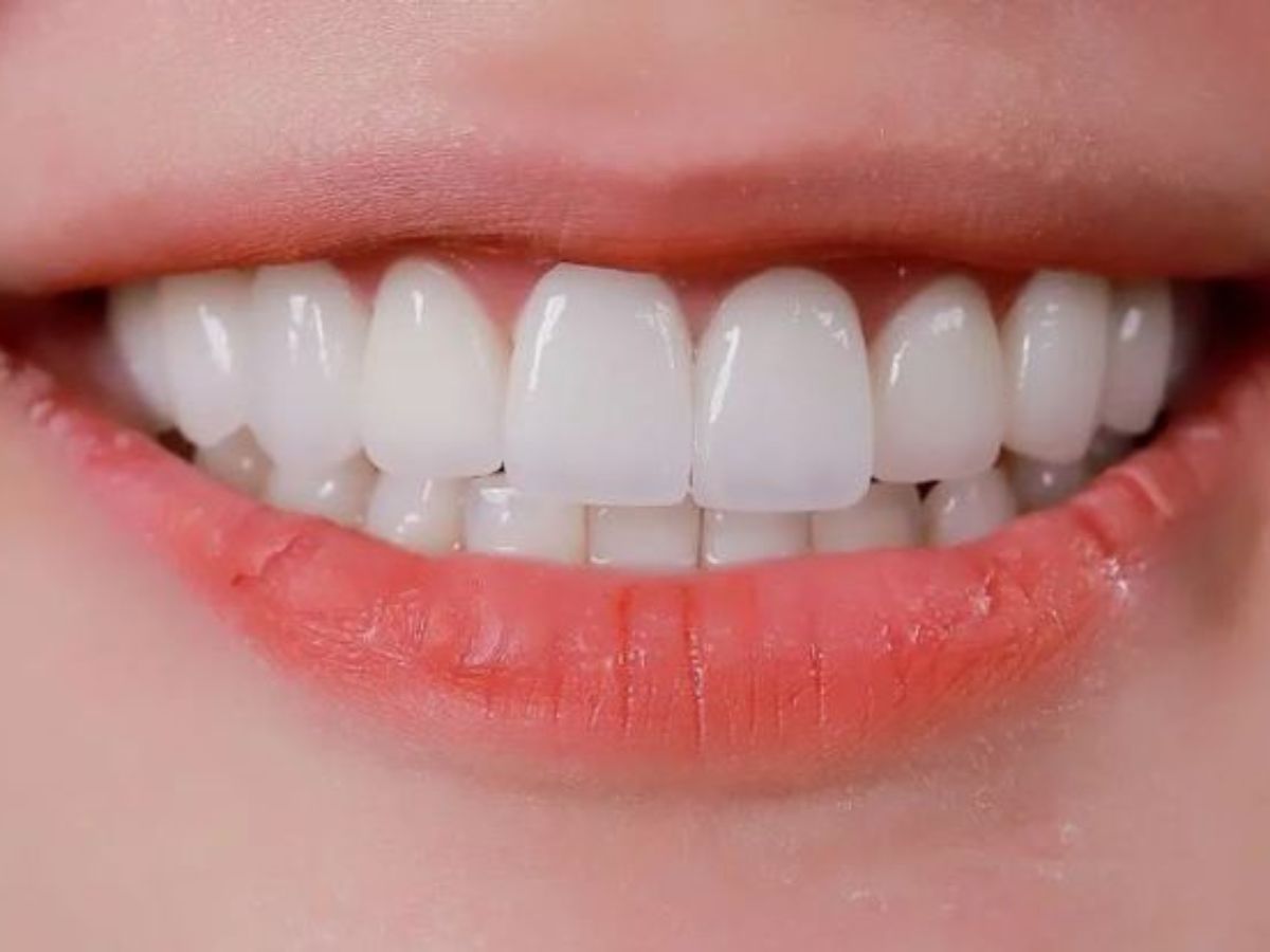 Những Sai Lầm Khiến Răng Sứ Nhanh Xuống Cấp Và Cách Chăm Sóc Đúng