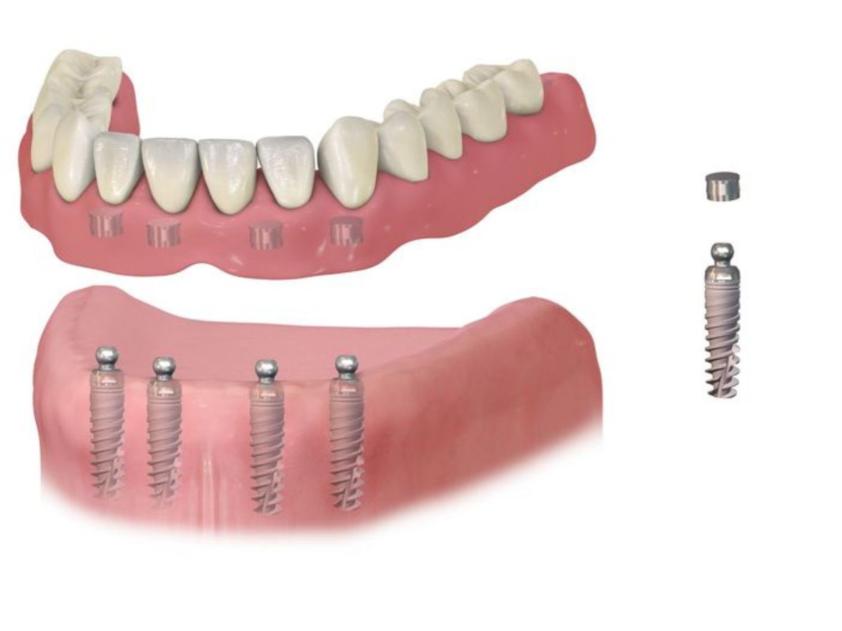 Người Cao Tuổi Có Trồng Implant Được Không? Điều Kiện Và Lưu Ý