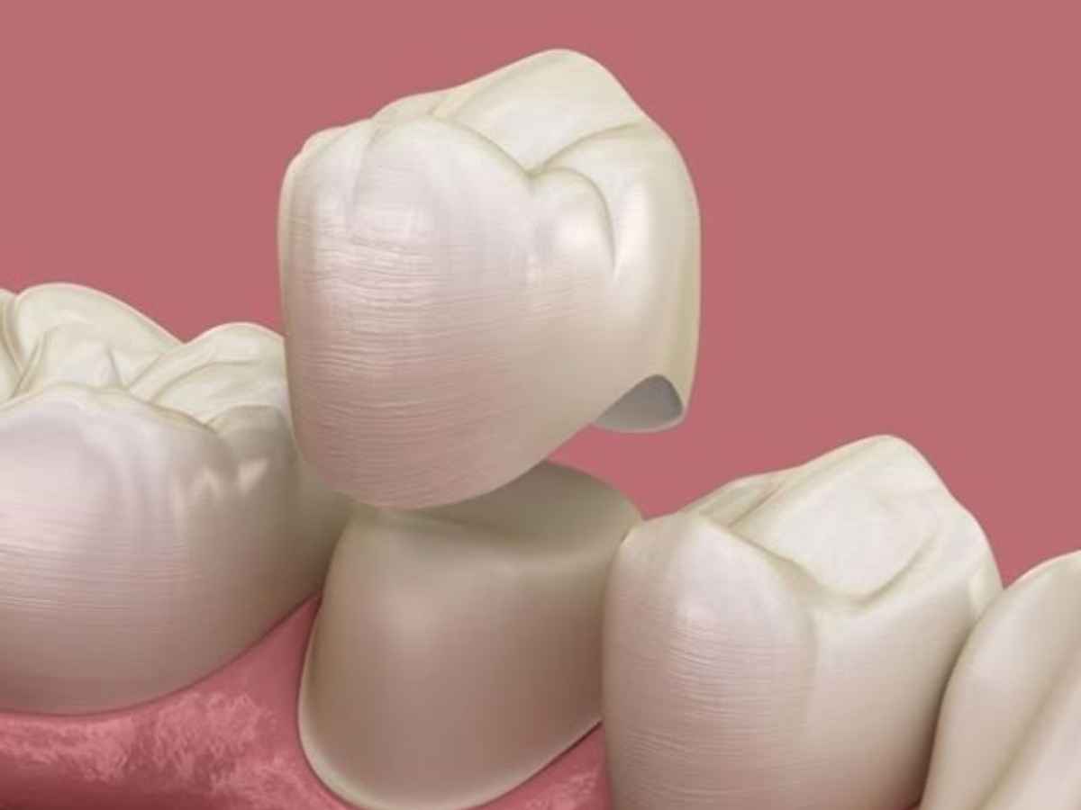 CÓ NÊN BỌC RĂNG SỨ KHI RĂNG VẪN CÒN KHỎE MẠNH?