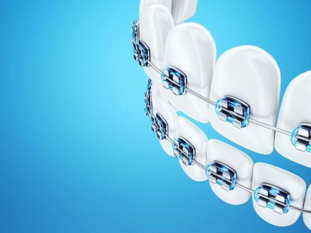 Người Trưởng Thành Niềng Răng Có Hiệu Quả Không? Có Muộn Không?