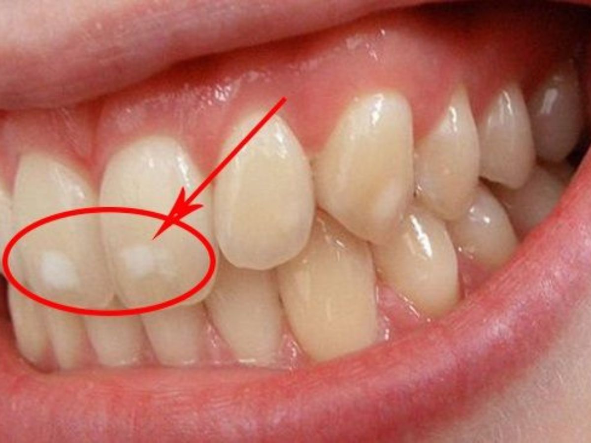 Đốm Trắng Trên Răng Là Dấu Hiệu Gì? Nguyên Nhân Và Cách Điều Trị