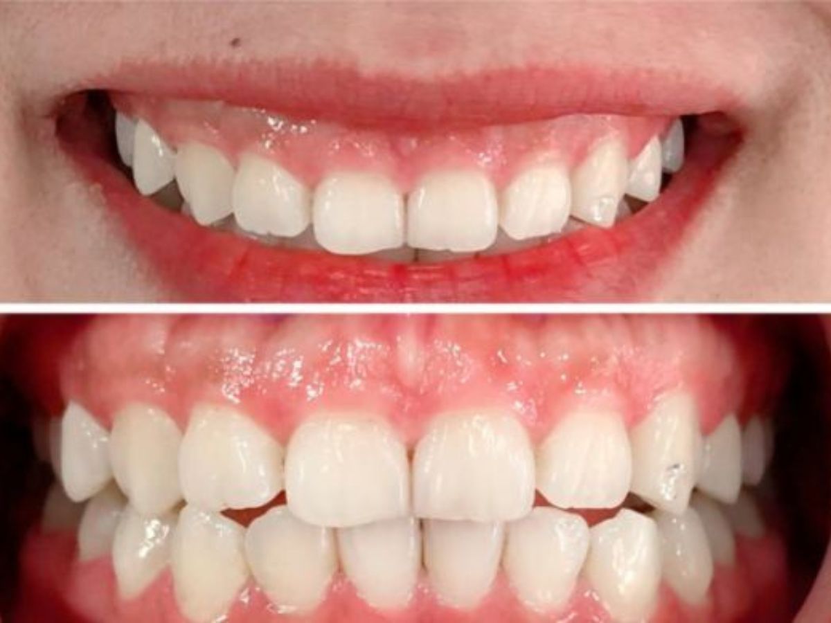 Cười hở lợi: Dấu hiệu, nguyên nhân và cách điều trị tại nha khoa