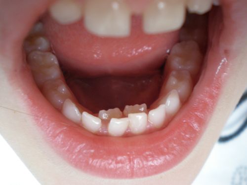 Trẻ Thay Răng Chậm Có Đáng Lo Không? Nguyên Nhân Và Cách Xử Lý Phù Hợp