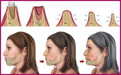 Đừng chủ quan với mất răng lâu năm – Hậu quả khó lường!