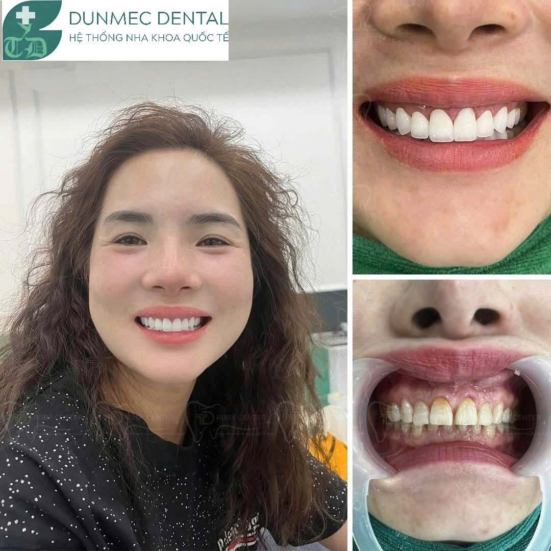 Răng sứ thẩm mỹ – Chìa khóa nâng tầm nhan sắc