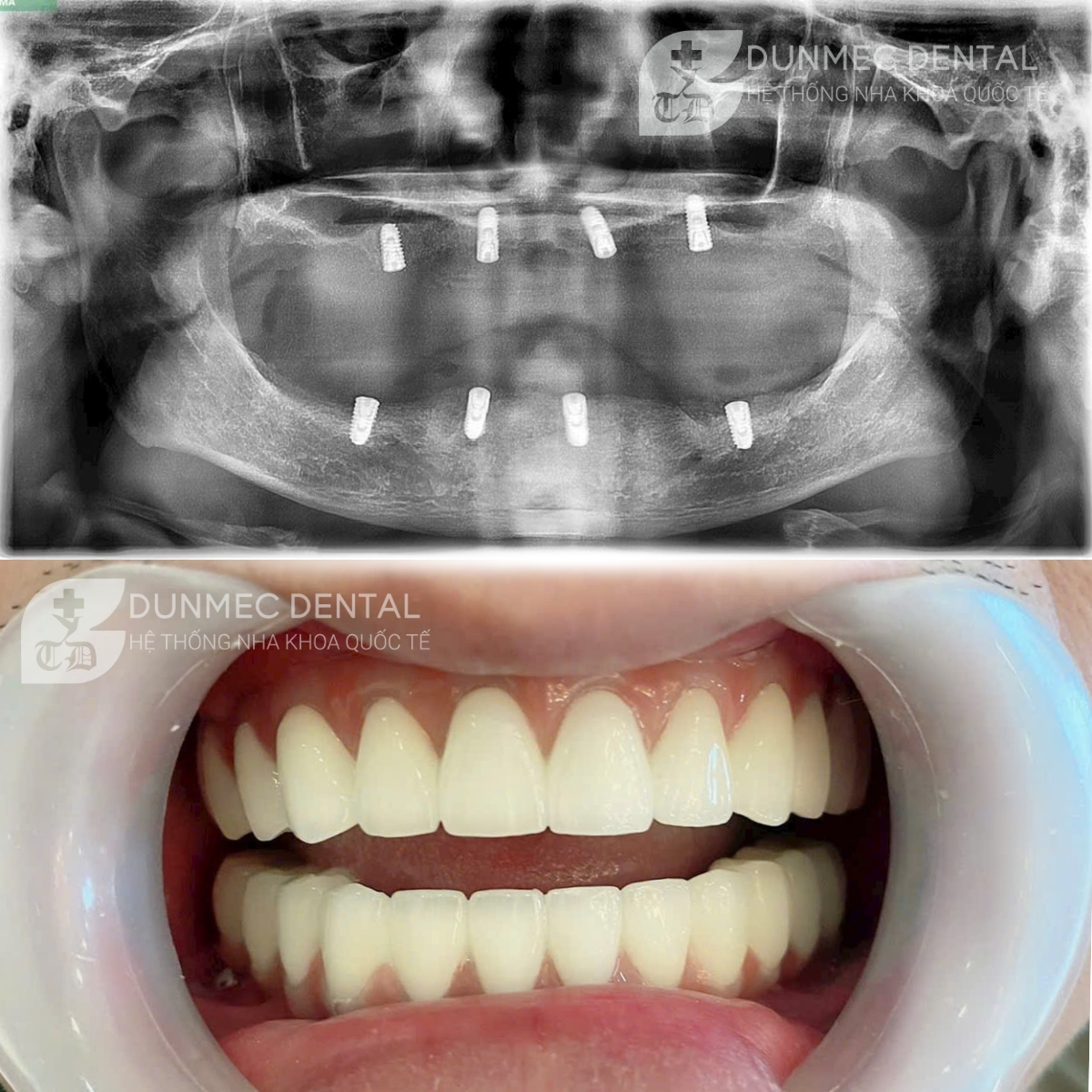 LỢI ÍCH VÀNG KHI TRỒNG RĂNG IMPLANT ĐÚNG LÚC TẠI DUNMEC DENTAL