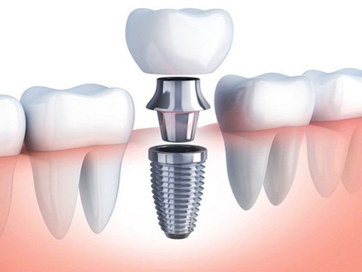 Đánh bay nỗi sợ khi trồng răng Implant