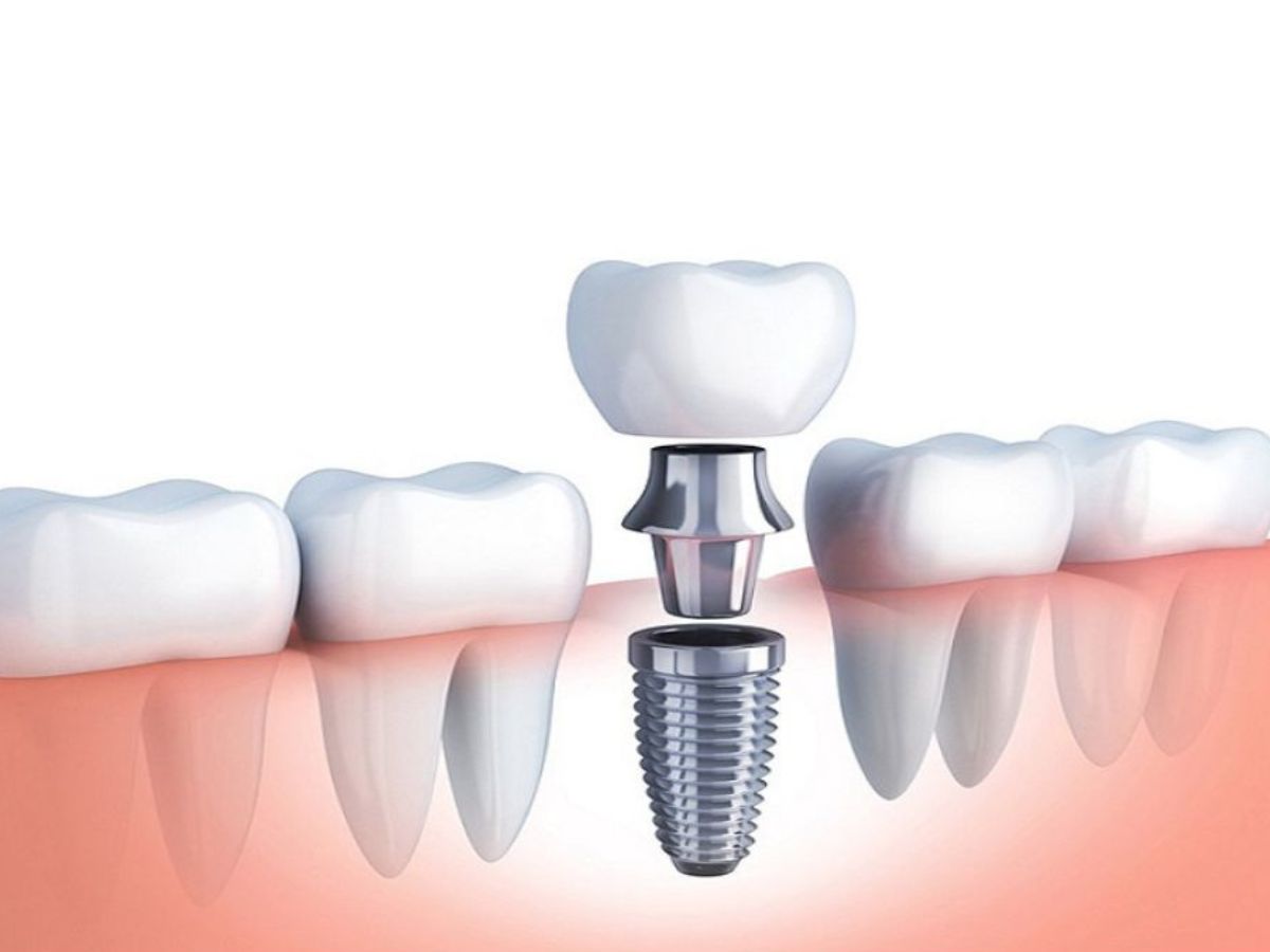 Trồng răng Implant vào độ tuổi nào thì phù hợp? Bác sĩ giải đáp chi tiết