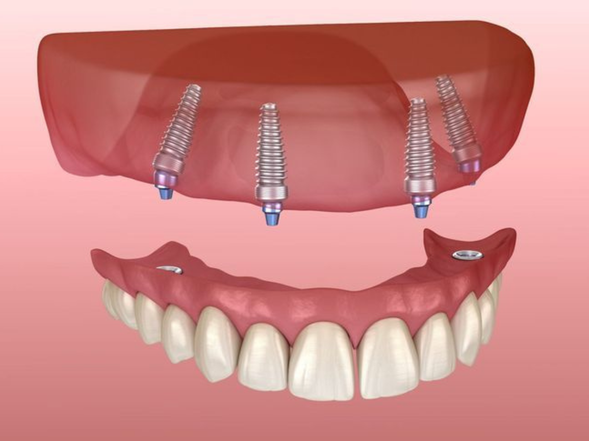 Trồng Răng Toàn Hàm All-on-4 – Ăn Nhai Tự Tin Như Răng Thật
