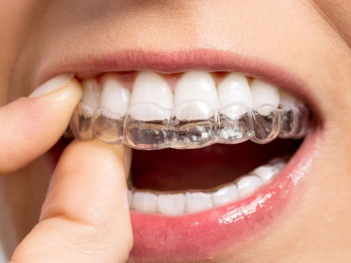 Sau niềng răng có nên đeo hàm duy trì không? Vai trò quan trọng nhiều người bỏ qua