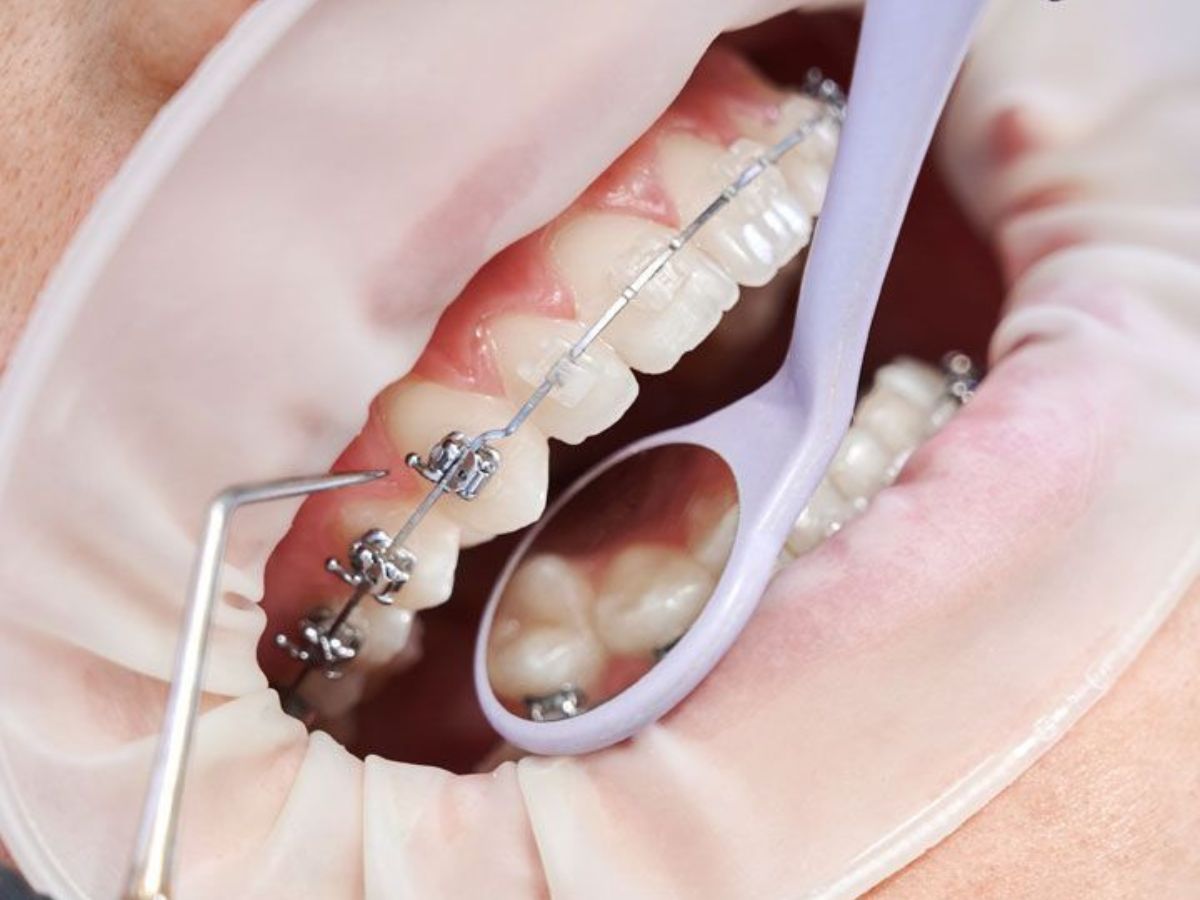 Vì Sao Bạn Nên Niềng Răng? Lợi Ích Thực Sự Khi Chỉnh Nha Sớm