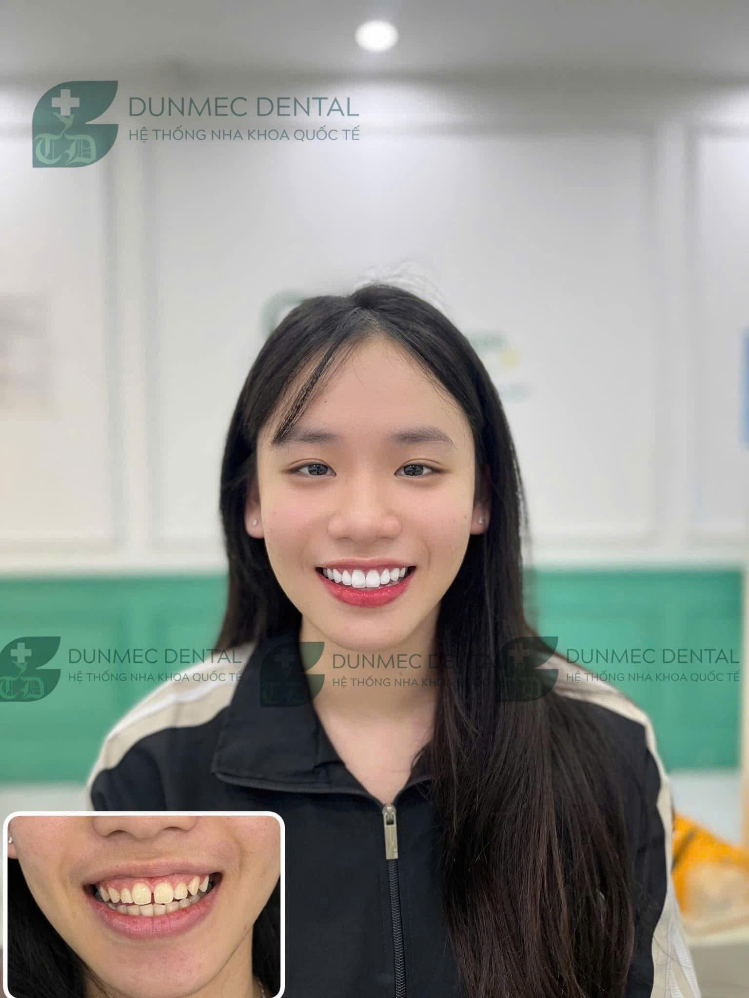 Răng sứ chuẩn dáng – Chuẩn tone – Chuẩn Dunmec: Nụ cười tự tin 