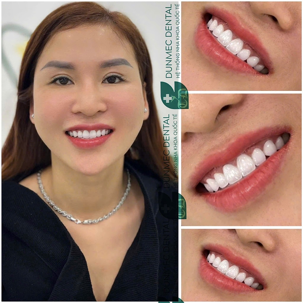 Có nên bọc răng sứ không? Răng sứ có tốt bằng răng thật không?