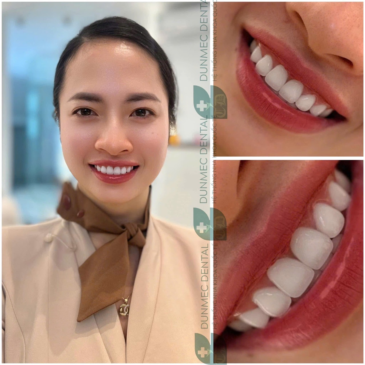 Có cần lấy tủy răng trước khi bọc răng sứ hay không?