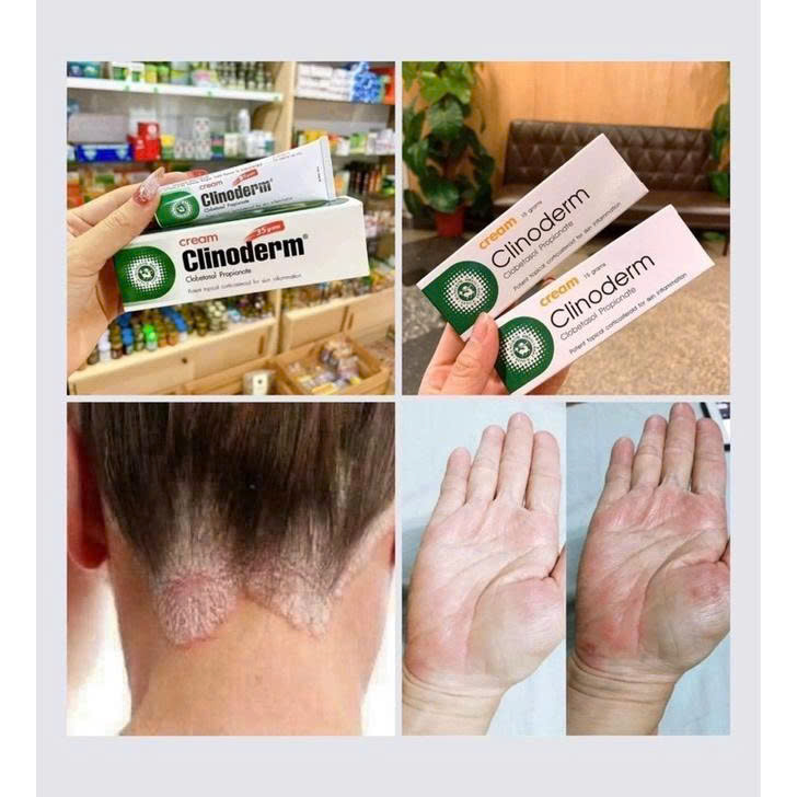 TUÝP NGỨA VẨY NẾN THÁI LAN - M121