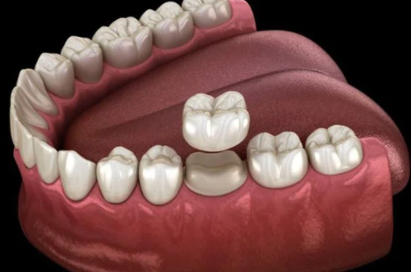 Bảo toàn tối đa răng gốc