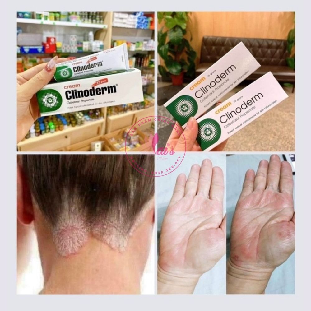 Kem Bôi Ngứa Vảy Nến Thái Lan Clinoderm Cream 15g Viêm Da Cơ Địa, Tổ Đỉa