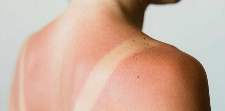 Da bị cháy nắng cần bao lâu để phục hồi và làm thế nào để