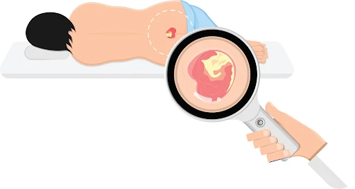 Các giai đoạn phát triển của loét do tì đè