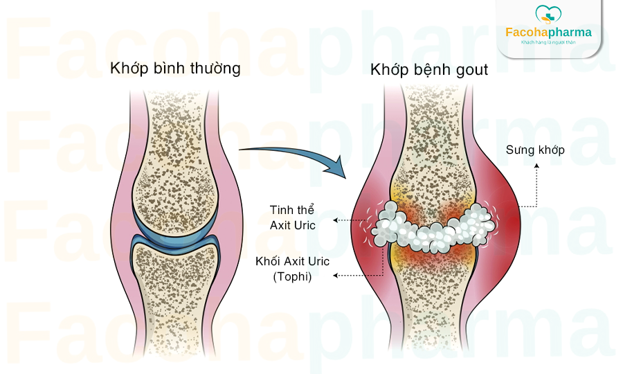 Đau nhức đầu gối do bệnh Gout